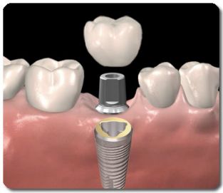 gerucht bord voorzetsel Wat zijn implantaten? | Praktijk voor Parodontologie en Implantologie Arnhem